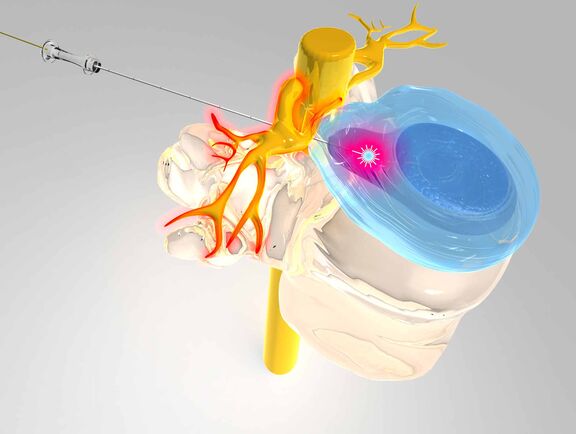 Operation vermeiden mit Hilfe der Mikrotherapie. Ein Zusatzangebot der KNAPPSCHAFT kann bei Rückenschmerzen helfen.