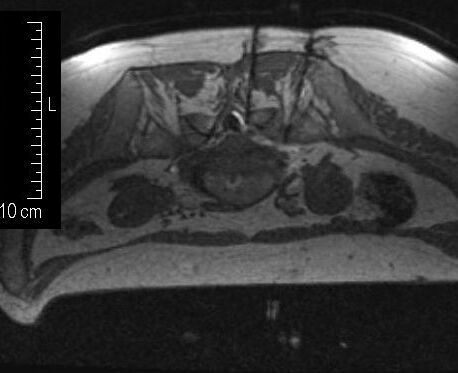 Nervenreizsyndrom - Therapie unter MRT- und CT-Steuerung