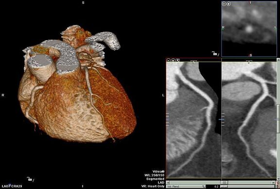 dreidimensionale Darstellung des Herzens und seiner Gefäßstrukturen im 3D Volumen CT