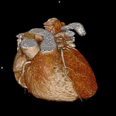 dreidimensionale Darstellung des Herzens und seiner Gefäßstrukturen im 3D Volumen CT