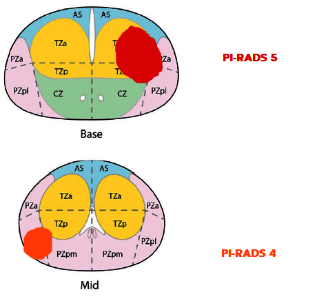 PI-RADS PIRADS.png