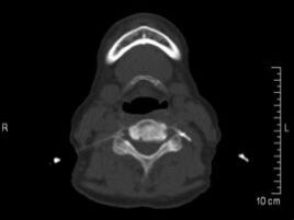 Hier sehen wir den Wirbelkörper der Halsregion, sowie den Kieferknochen und die Zähne. Therapie der Arthrose der Facettengelenke an der Halswirbelsäule