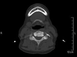 Therapie der Arthrose der Facettengelenke an der Halswirbelsäule