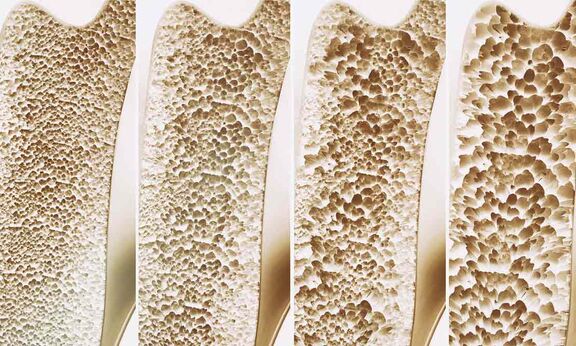 Osteoporose - Starke, gesunde Knochen im Alter sind keine Selbstverständlichkeit