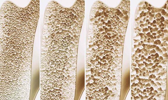 Osteoporose - Starke, gesunde Knochen im Alter sind keine Selbstverständlichkeit Osteoporose - Starke, gesunde Knochen im Alter sind keine Selbstverständlichkeit