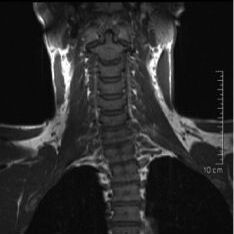 Iliosakralgelenk Arthrose (ISG Arthrose) - Verschleiß des Kreuzbein-Darmbein-Gelenks kann Skoliose verursachen.