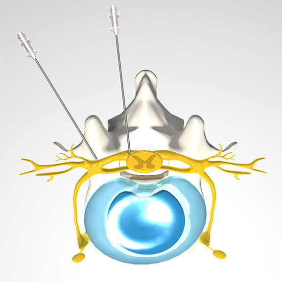 Mikrotherapie: Nadeln, Kanülen oder Endoskope platzieren wir punktgenau und präzise in den verschiedensten Körperregionen, ohne Verletzungen von lebenswichtigen Organen, Gefäßen oder Nerven zu riskieren