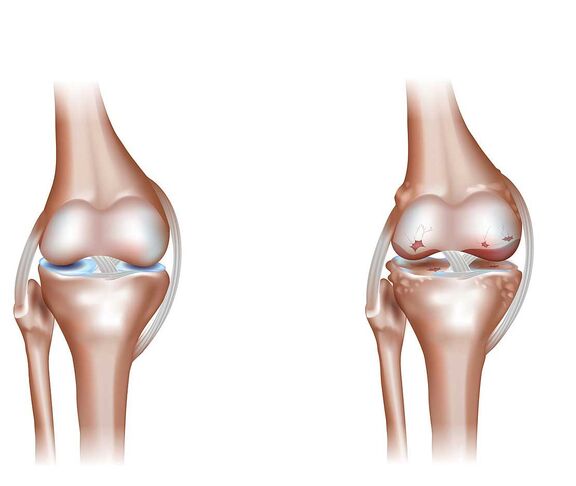 Osteoporose, einer Erkrankung des Knochenstoffwechsels