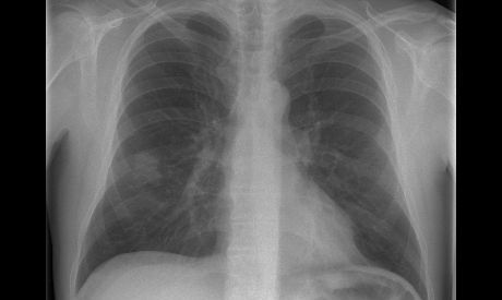 Digitales Röntgen - Röntgenaufnahme des Thorax