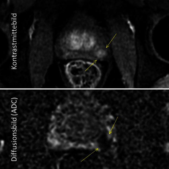 Prostata-MRT: Diffusionswichtung Prostata-MRT: Diffusionswichtung