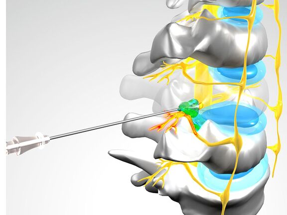 Therapie gereizter Nerven (PRT) mittels MikroTherapie (HWS)