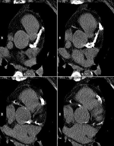 Kardio-CT Darstellung verkalkter Herzkranzgefäße. Untersuchung auch mit Herzschrittmacher möglich. Kardio-CT Darstellung verkalkter Herzkranzgefäße. Untersuchung auch mit Herzschrittmacher möglich.