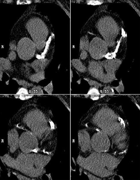 Kardio-CT Darstellung verkalkter Herzkranzgefäße. Untersuchung auch mit Herzschrittmacher möglich.