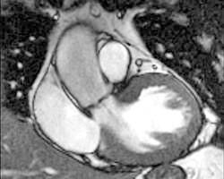 Kardio-MRT: Herz Darstellung in der MRT - dem Herzmuskel bei der Arbeit zusehen im Rahmen der MRT Vitalitätsdiagnostik.