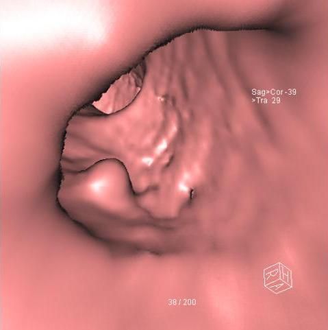 Dreidimensionale Darstellung eines Polyps im Dickdarm Dreidimensionale_Darstellung_eines_Polyps_im_Dickdarm.jpg